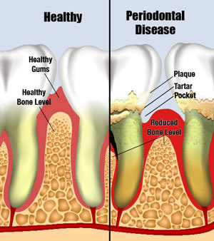 Periodontal Disease